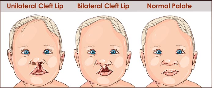 complete cleft lip