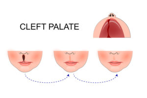 Cleft Palate - Cleft & Craniofacial Institute of Utah