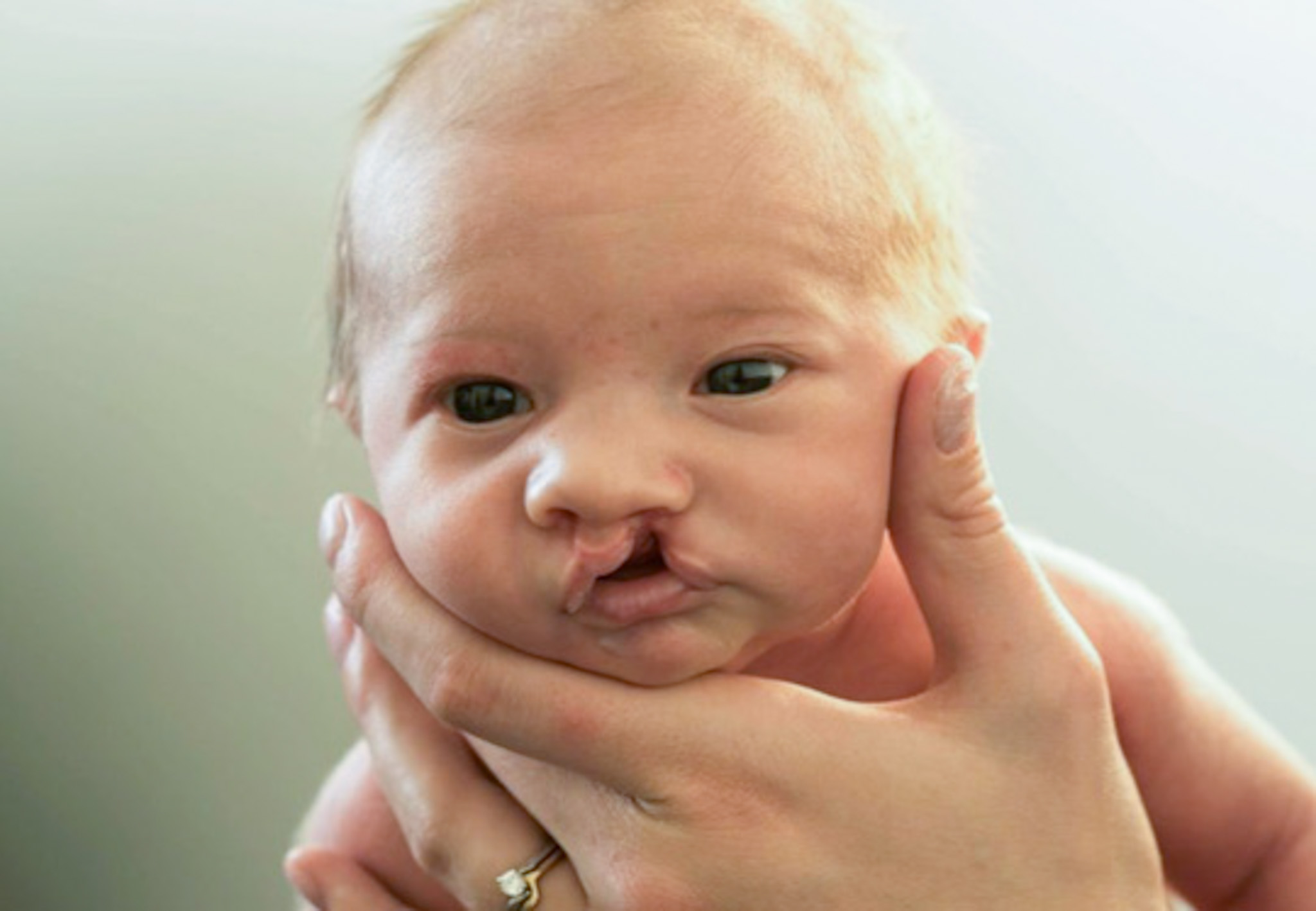 Phoenix Children's on X: July is National Cleft & Craniofacial